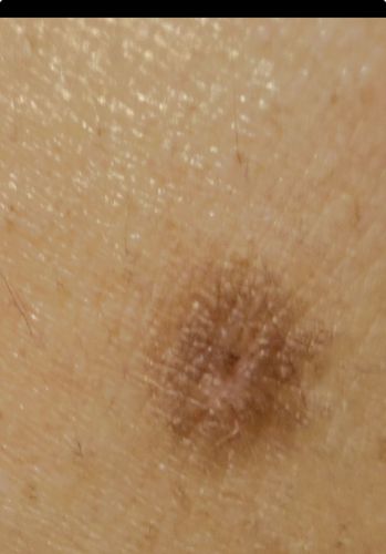 Not a bug/insect (Likely a skin lesion or mole)