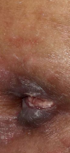 No insect visible