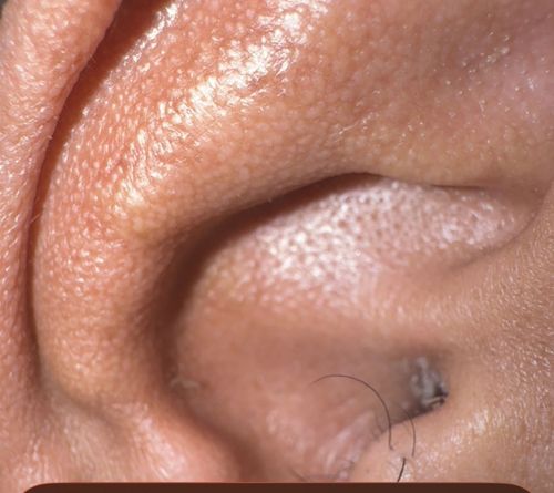 Ear Mite