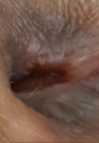 Unidentifiable Object (Likely Debris, Earwax, or dried fluid)