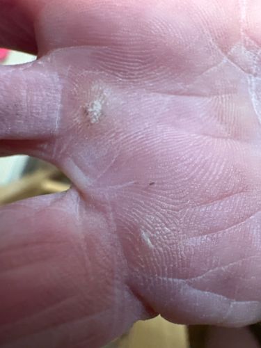 Human Scabies Mite