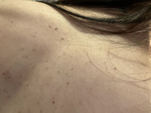 Mole or Freckle