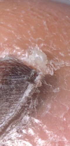 Itch mite