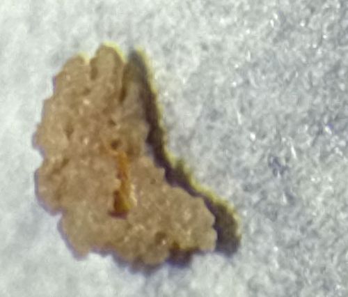 Tonsil Stone (Tonsillolith)