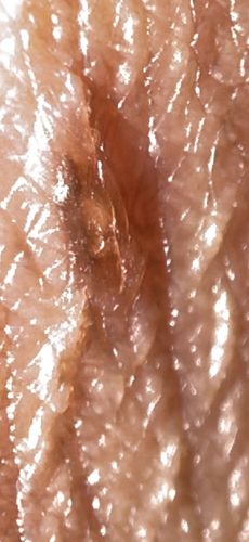 Itch Mite (Scabies Mite)
