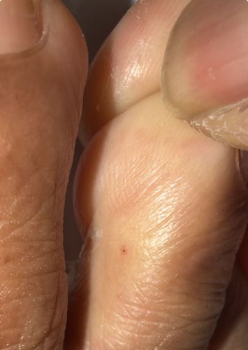 Chigoe flea (also known as sand flea, jigger, or nigua)