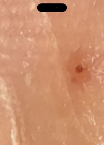 Hard Tick
