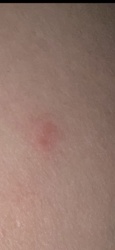 Mosquito (Mosquito Bite)