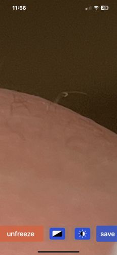 Pinworm (Human Threadworm)