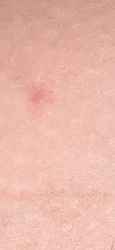Mosquito (Mosquito Bite)