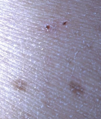 Scabies Mite (also known as the Itch Mite)