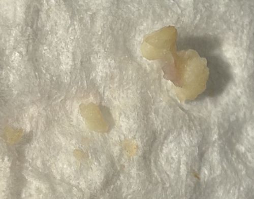 Not a bug (Likely Tonsil Stone or Food Debris)