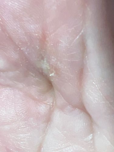 Sarcoptic Mange Mite