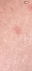Unknown (red mark on skin)