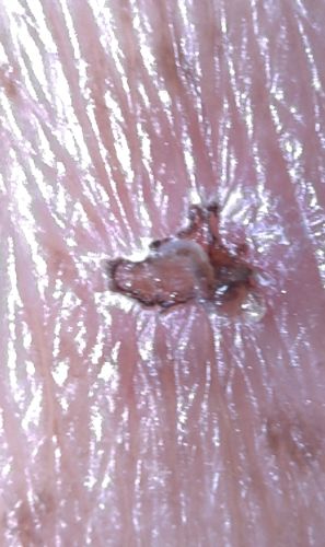 Scabies Mite (also known as Sarcoptes scabiei)