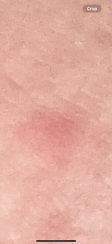 Mosquito (presumed bite reaction)