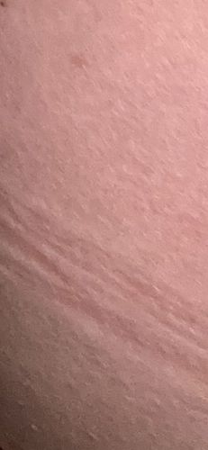 Scabies Mite (or similar microscopic skin mite)