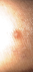 Chigger (Harvest Mite)