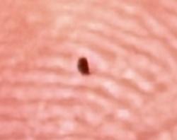 Black legged tick (Deer tick)
