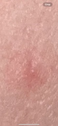 Unknown (Likely a skin reaction, not an insect)