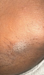 Itch mite