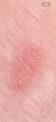 Not identifiable as an insect from the image; appears to be a skin reaction (e.g., insect bite or rash)