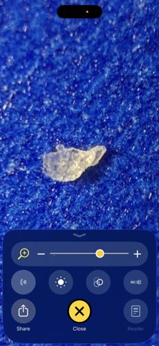 Skin-like particulate / Potential Dried Exudate