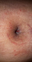 Human Botfly (Larva)