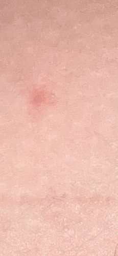 Mosquito (Mosquito Bite)