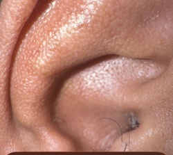Ear Mite
