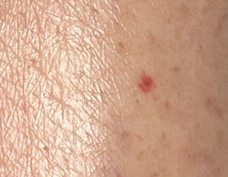 Chigger