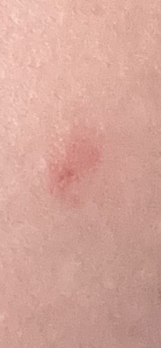 Mosquito (Bite)