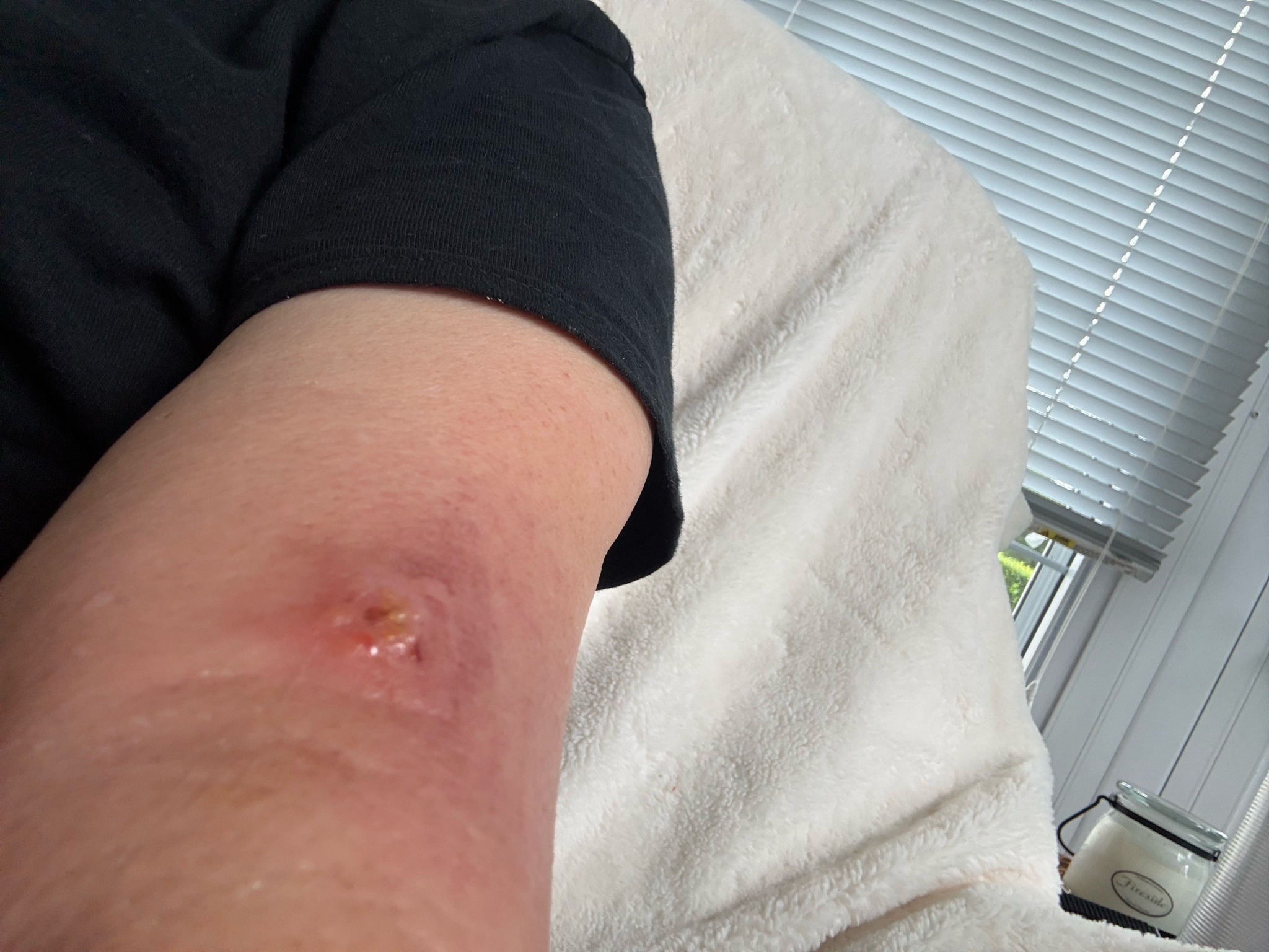 Unknown (Injury/Bite site)