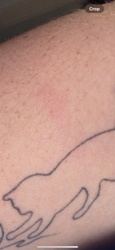 No insect is visible in the image. The image shows a single pinkish-red mark on human skin, resembling an insect bite or rash.