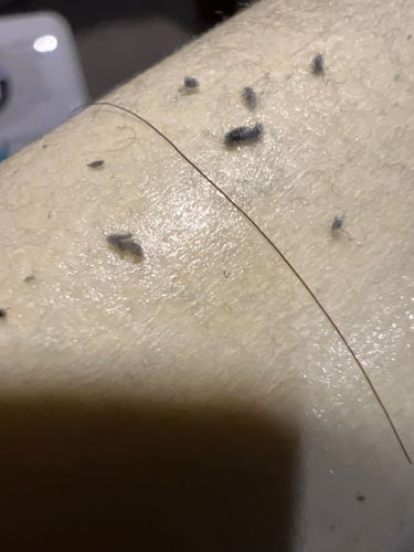 There is no identifiable insect or bug in the provided image. The image appears to show lint, dust, or other small debris on skin, along with a stray hair.