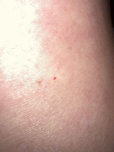 Chigger (Larval Mite)