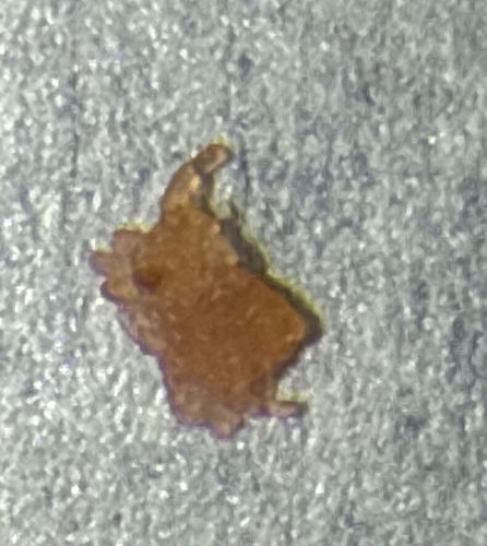 Pubic Louse (Crab Louse)