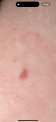N/A - The image displays a red mark or rash on skin, not an insect.