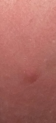 Unknown skin irritation/bite mark
