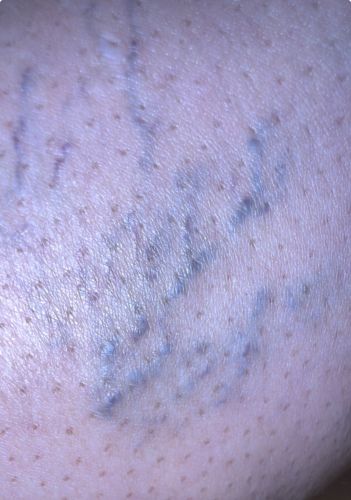 Not a bug (Spider Veins/Varicose Veins)