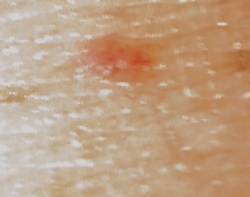Chigger (Harvest Mite Larva)