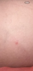 N/A - Image shows a bite/rash, not an insect.