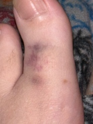Not an insect or bug; this appears to be a bruise on a human foot.