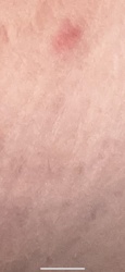 Unknown (likely a bite mark or skin irritation, not an insect)