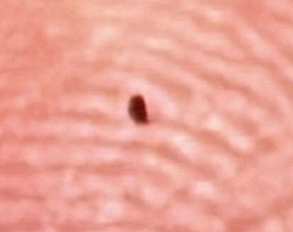 Black legged tick (Deer tick)