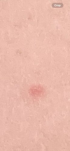 Embedded Tick (possible larva or nymph)