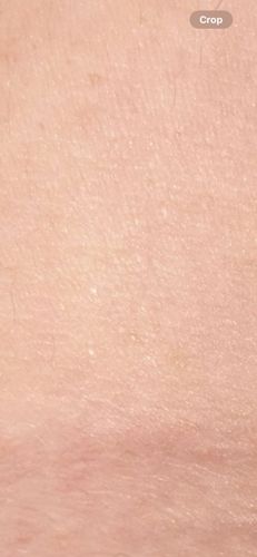 Human Skin (No insect or bug identifiable)