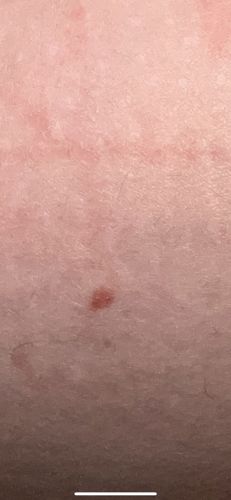 Unknown (potential tick bite/skin irritation)