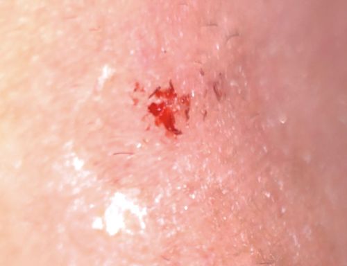 Pubic Louse (Crab Louse)