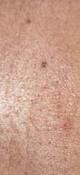Itch mite